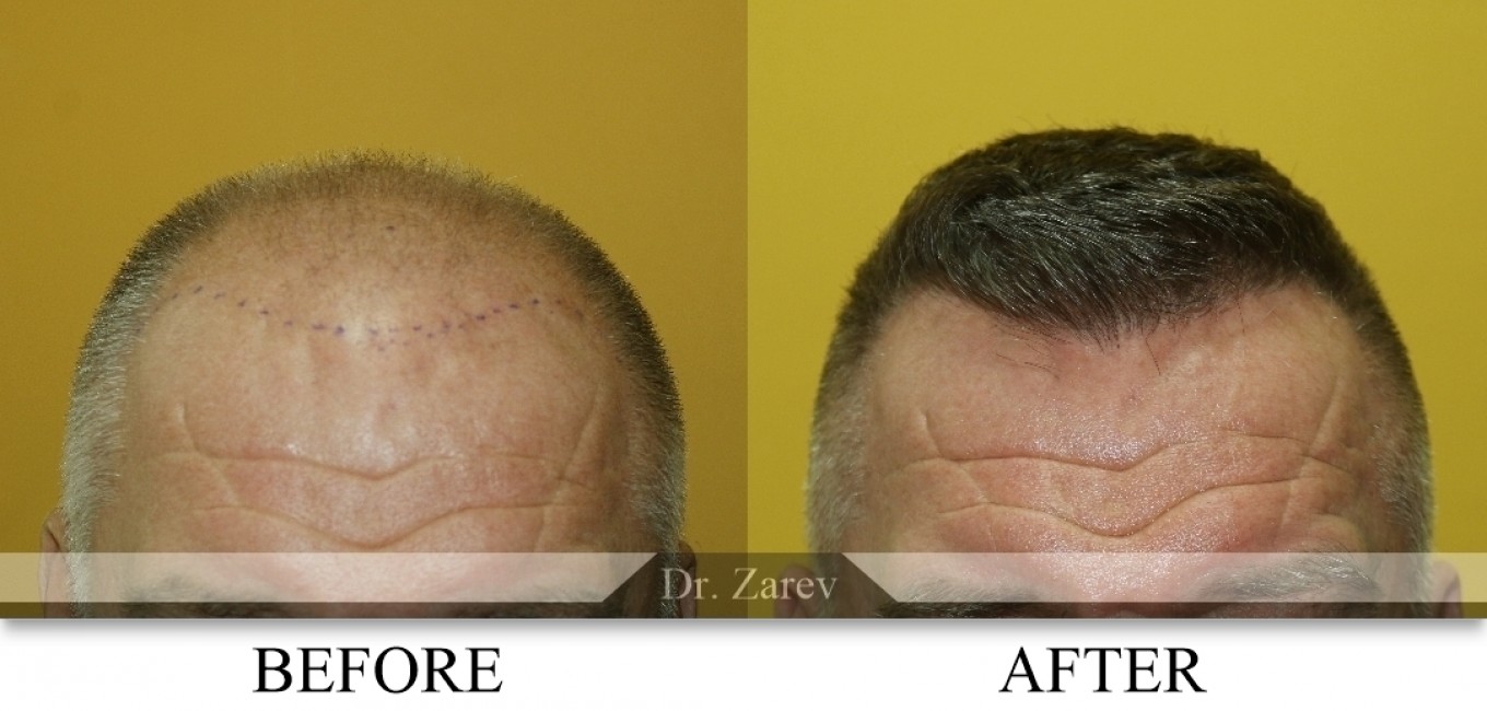 The World's Top 25 Hair Transplant Surgeons: 2021 Edition