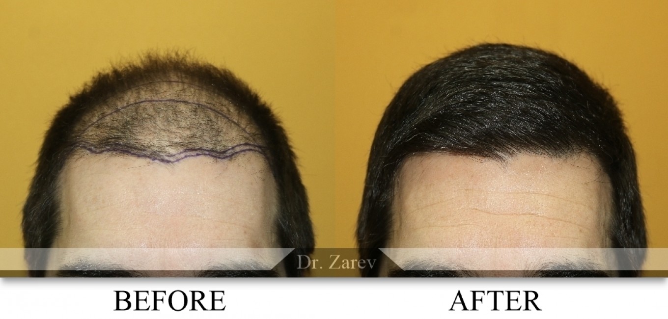Hair Transplantation Fifth Edition（洋書） Amazon.co.jp: Riquette Hofstein: 洋書