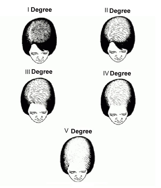 Androgenic Alopecia- AKA Male and female pattern baldness