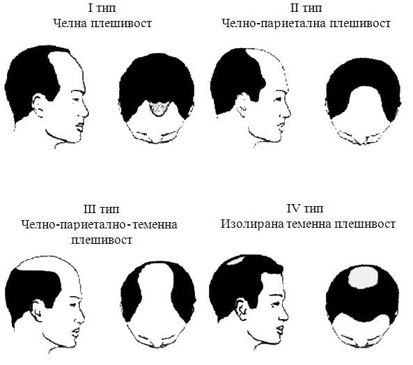 Класификация на мъжката плешивост