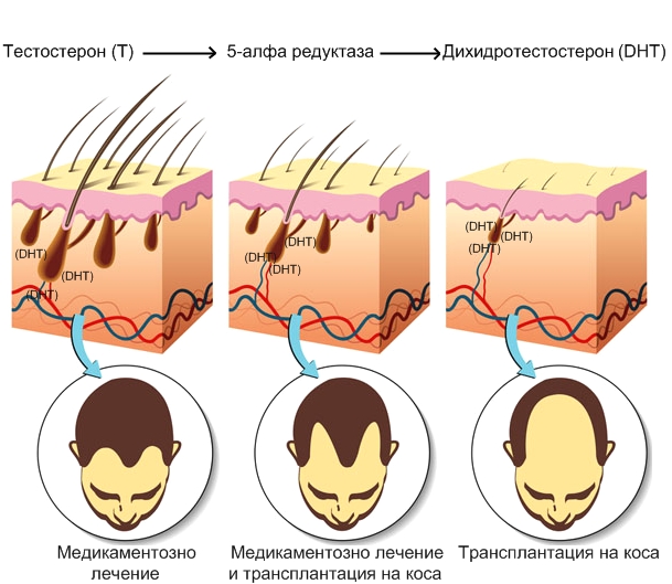 Tрансплантация на коса AVE FUE 