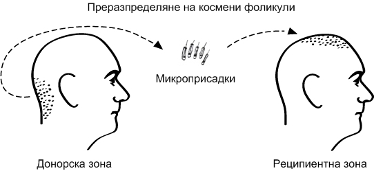 Преразпределяне на космени фоликули при трансплантация на коса